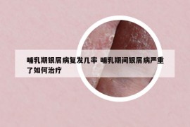 哺乳期銀屑病復發(fā)幾率 哺乳期間銀屑病嚴重了如何治療