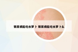 銀屑病能吃水蘿卜 銀屑病能吃水蘿卜么
