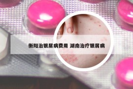衡陽治銀屑病費用 湖南治療銀屑病