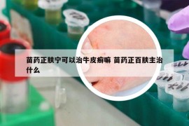 苗藥正膚寧可以治牛皮癬嘛 苗藥正百膚主治什么