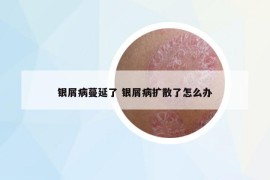 銀屑病蔓延了 銀屑病擴散了怎么辦