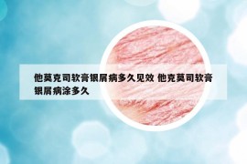 他莫克司軟膏銀屑病多久見效 他克莫司軟膏銀屑病涂多久