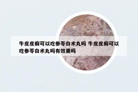 牛皮皮癬可以吃參苓白術(shù)丸嗎 牛皮皮癬可以吃參苓白術(shù)丸嗎有效果嗎