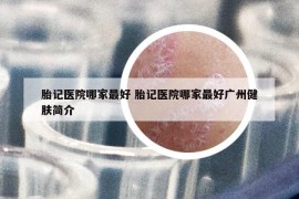 胎記醫(yī)院哪家最好 胎記醫(yī)院哪家最好廣州健膚簡(jiǎn)介