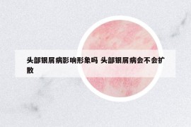 頭部銀屑病影響形象嗎 頭部銀屑病會不會擴散