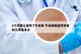 6個(gè)月嬰兒遺傳了牛皮癬 牛皮膚癬遺傳寶寶的幾率是多少