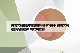 陰囊大腿根部?jī)?nèi)側(cè)瘙癢有蘚咋回事 陰囊大腿根部?jī)?nèi)側(cè)瘙癢 有紅斑皮屑
