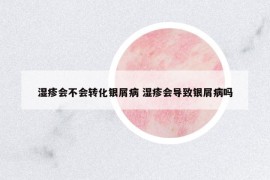 濕疹會不會轉(zhuǎn)化銀屑病 濕疹會導(dǎo)致銀屑病嗎