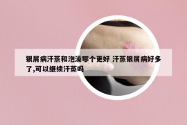 銀屑病汗蒸和泡澡哪個(gè)更好 汗蒸銀屑病好多了,可以繼續(xù)汗蒸嗎