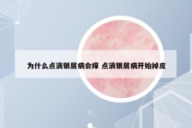 為什么點(diǎn)滴銀屑病會(huì)癢 點(diǎn)滴銀屑病開始掉皮