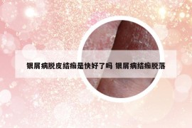 銀屑病脫皮結(jié)痂是快好了嗎 銀屑病結(jié)痂脫落