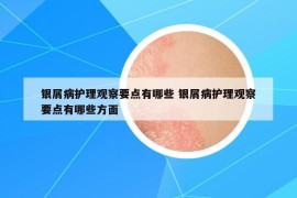銀屑病護理觀察要點有哪些 銀屑病護理觀察要點有哪些方面