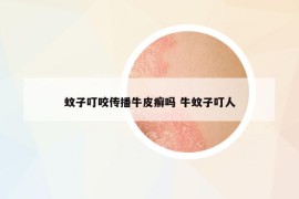 蚊子叮咬傳播牛皮癬嗎 牛蚊子叮人