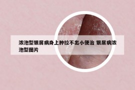 濃泡型銀屑病身上腫拉不出小便治 銀屑病濃泡型圖片