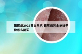 銀屑病2023蘇金單抗 銀屑病蘇金單抗干粉怎么能買