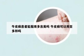 牛皮癬患者能服用多吉美嗎 牛皮癬可以用百多邦嗎
