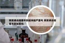 銀屑病會隨著年齡越來越嚴(yán)重嗎 銀屑病會隨著年齡加重嗎