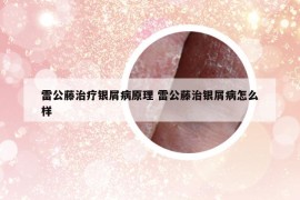 雷公藤治療銀屑病原理 雷公藤治銀屑病怎么樣