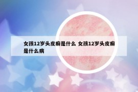 女孩12歲頭皮癬是什么 女孩12歲頭皮癬是什么病