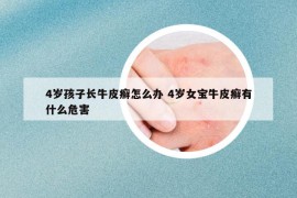 4歲孩子長牛皮癬怎么辦 4歲女寶牛皮癬有什么危害