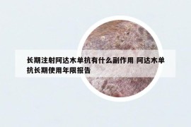 長期注射阿達木單抗有什么副作用 阿達木單抗長期使用年限報告