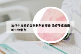治療牛皮癬的生物制劑有哪些 治療牛皮病癬的生物制劑