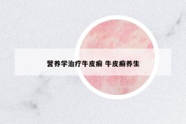 營養(yǎng)學(xué)治療牛皮癬 牛皮癬養(yǎng)生