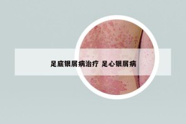 足底銀屑病治療 足心銀屑病