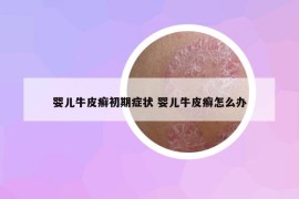 嬰兒牛皮癬初期癥狀 嬰兒牛皮癬怎么辦