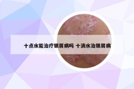 十點(diǎn)水能治療銀屑病嗎 十滴水治銀屑病