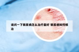 請(qǐng)問一下銀屑病怎么治療最好 銀屑病如何根冶
