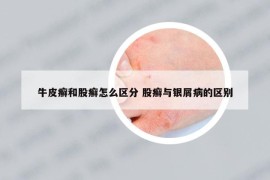 牛皮癬和股癬怎么區(qū)分 股癬與銀屑病的區(qū)別