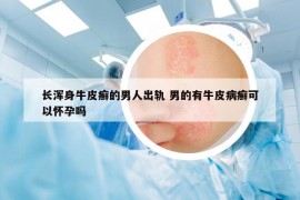 長渾身牛皮癬的男人出軌 男的有牛皮病癬可以懷孕嗎