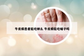 牛皮癬患者能吃蟬么 牛皮癬能吃蛹子嗎