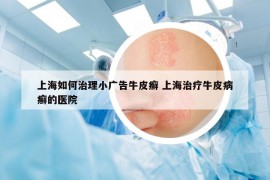 上海如何治理小廣告牛皮癬 上海治療牛皮病癬的醫(yī)院