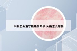 頭癬怎么治才能斷根知乎 頭癬怎么除根