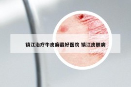 鎮(zhèn)江治療牛皮癬最好醫(yī)院 鎮(zhèn)江皮膚病