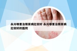 永川哪里治銀屑病比較好 永川哪里治銀屑病比較好的醫(yī)院