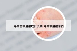 尋常型銀屑病吃什么菜 尋常銀屑病忌口