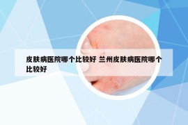 皮膚病醫(yī)院哪個(gè)比較好 蘭州皮膚病醫(yī)院哪個(gè)比較好