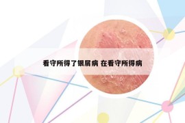 看守所得了銀屑病 在看守所得病