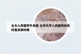 北大人民醫(yī)院牛皮癬 北京大學人民醫(yī)院的皮科是皮膚科嘛
