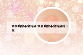 銀屑病會(huì)不會(huì)傳染 銀屑病會(huì)不會(huì)傳染給下一代