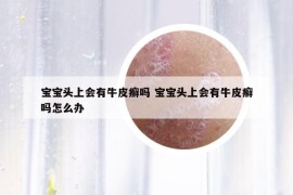 寶寶頭上會(huì)有牛皮癬嗎 寶寶頭上會(huì)有牛皮癬嗎怎么辦