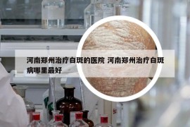 河南鄭州治療白斑的醫(yī)院 河南鄭州治療白斑病哪里最好