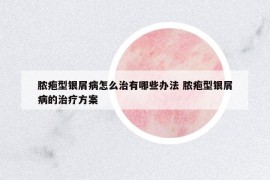 膿皰型銀屑病怎么治有哪些辦法 膿皰型銀屑病的治療方案