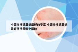 中國治療銀屑病最好的專家 中國治療銀屑病最好醫(yī)院是哪個醫(yī)院