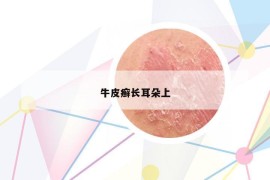 牛皮癬長(zhǎng)耳朵上