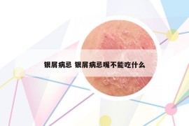 銀屑病忌 銀屑病忌嘴不能吃什么