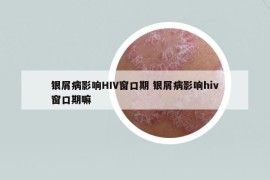 銀屑病影響HIV窗口期 銀屑病影響hiv窗口期嘛
